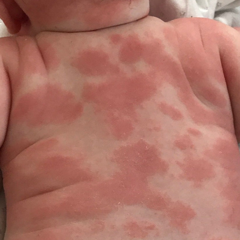 Baby with red rash on skin, wearing a diaper